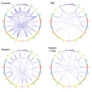 brain_connections_in_autism2